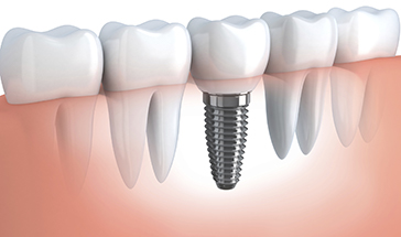 dental implants  in Horsham